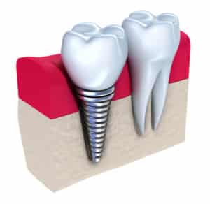 vivaimplants