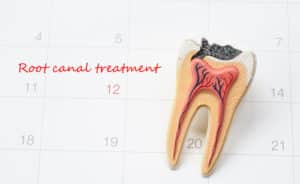 viva-root-canal