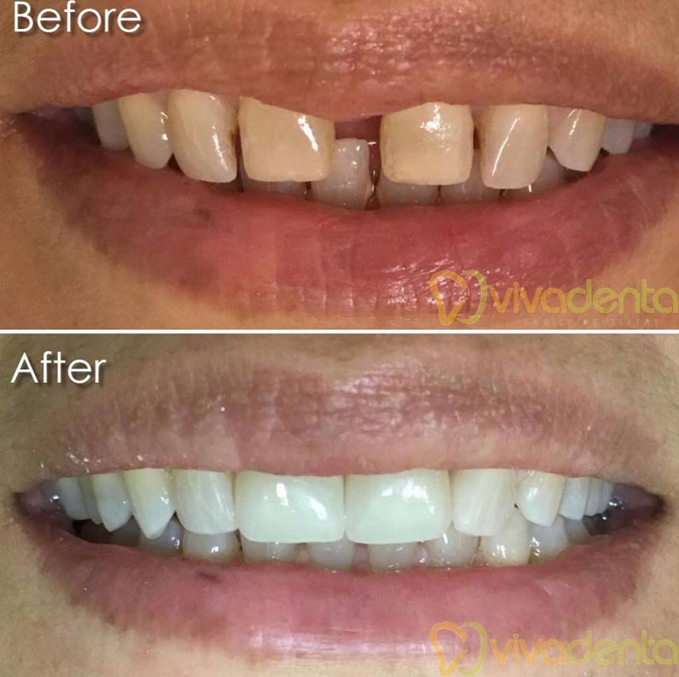 Invisalign Clear Aligners in Spring, TX