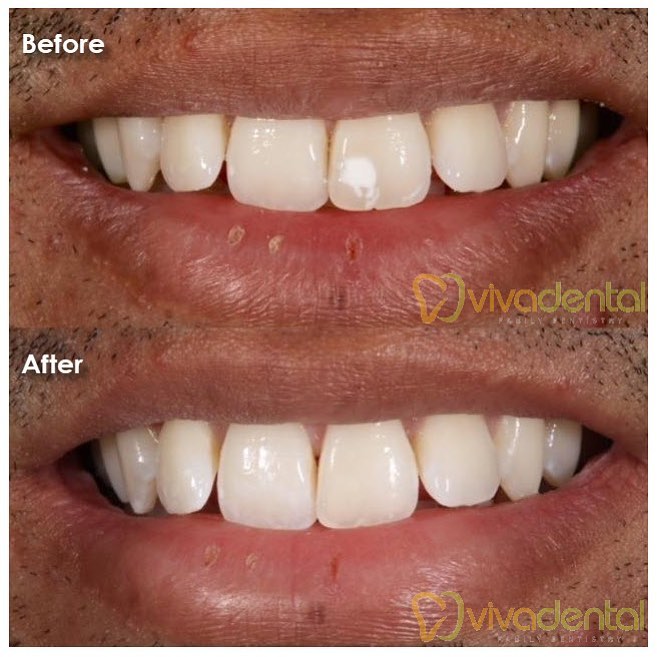 TeethWhitening Dallas, TX Richardson, TX