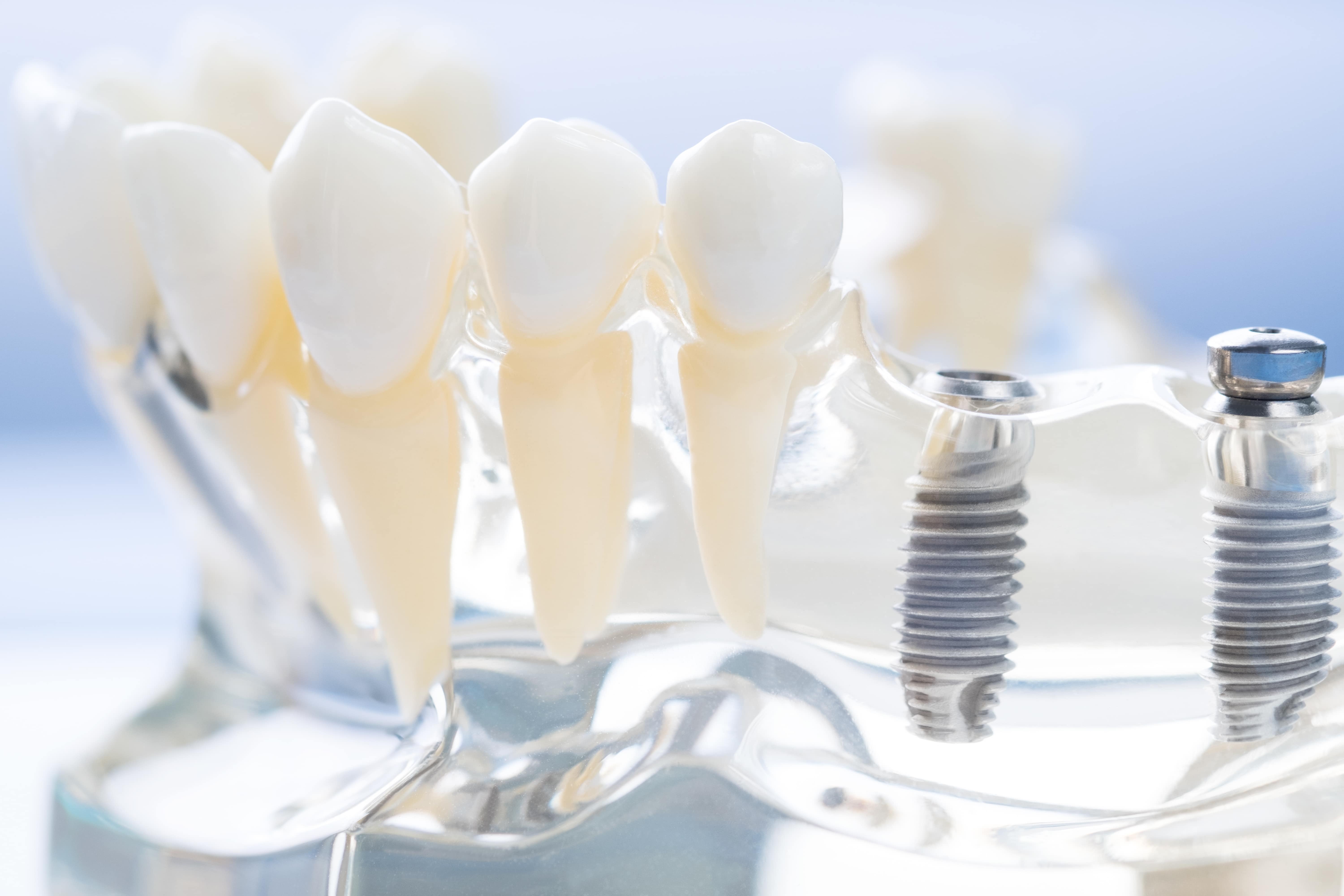 Dallas Dentist Looks At 5 Benefits Of Dental Implants Dallas, TX