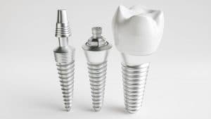 dental implants