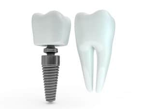 dallas dental implants