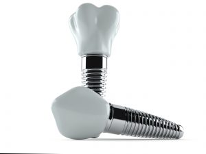 richardson dental implants