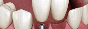 dallas dental restorations