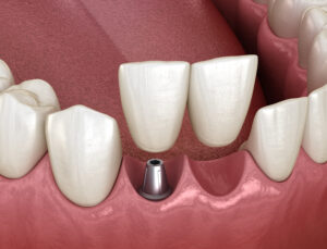 dallas dental restorations