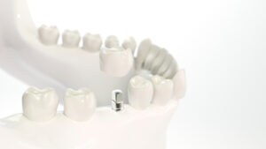dallas dental implants