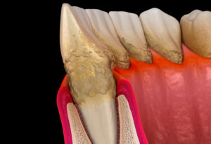 richardson gum disease