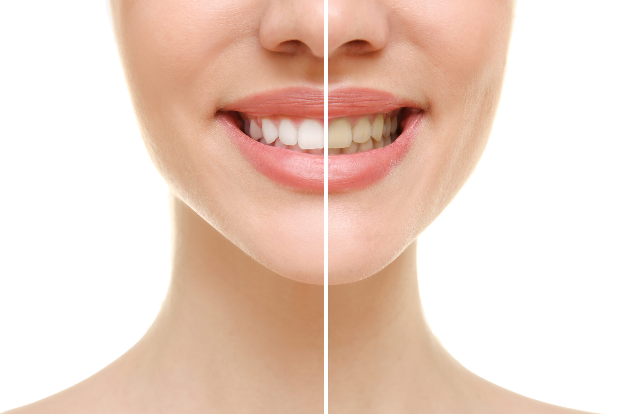 How We Brighten Smiles With Teeth Whitening Dallas, TX