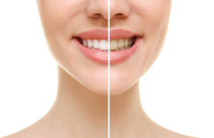 dallas teeth whitening