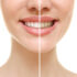 How We Brighten Smiles With Teeth Whitening
