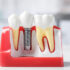 Dental Implants Secure Lifelike Tooth Replacement
