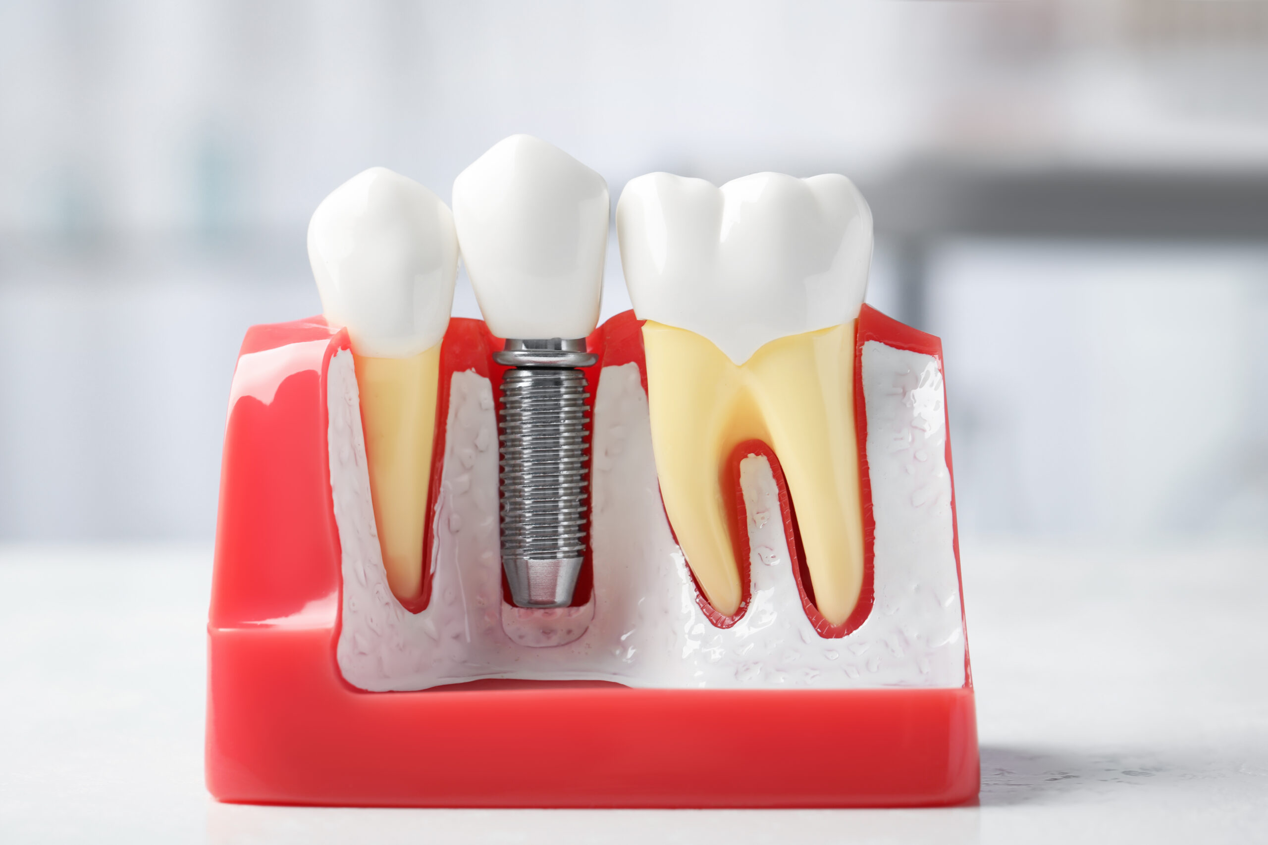 Implants Secure Lifelike Tooth Replacement Dallas, TX