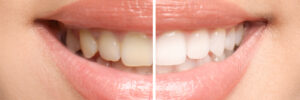 richardson teeth whitening