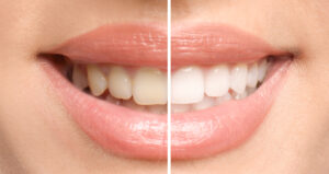 richardson teeth whitening