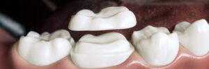 richardson dental crown