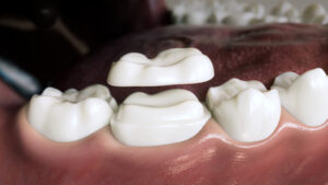 richardson dental crown