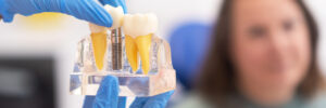 richardson dental implants