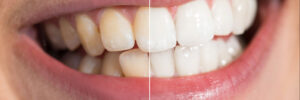 dallas teeth whitening
