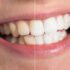 How Do We Brighten Your Teeth?